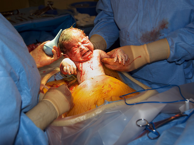 How to Prepare For a Cesarean Section - Torontek